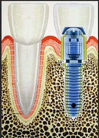 implantes dentales en Madrid